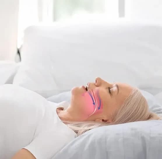 Obstructive Sleep Apnoea