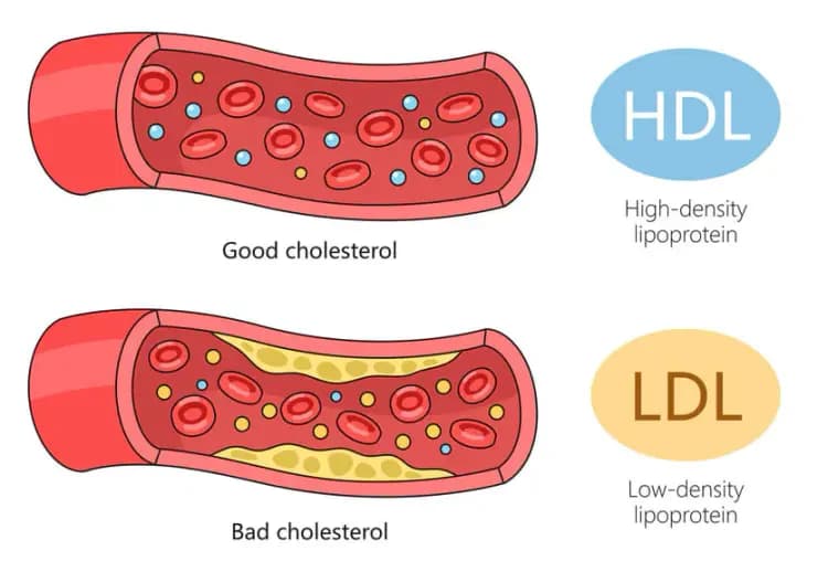 Good cholesterol HDL and bad cholesterol LDL